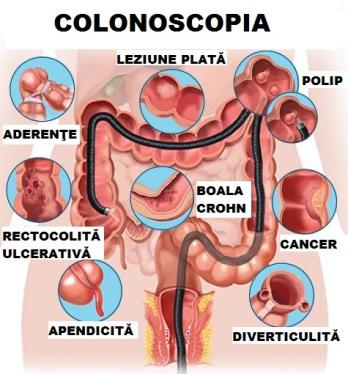 Simptomele bolii Crohn, Colită și dureri articulare