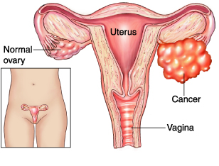 cancerul la ovare simptome