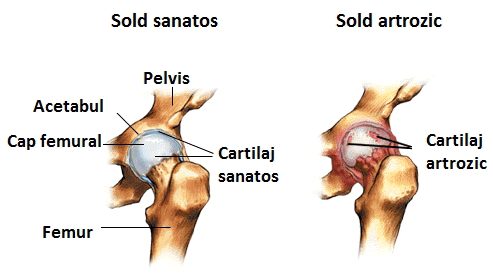 Proteza de Şold (Artroplastia Totală de Şold) | Ortopedia pe Înţelesul Tuturor