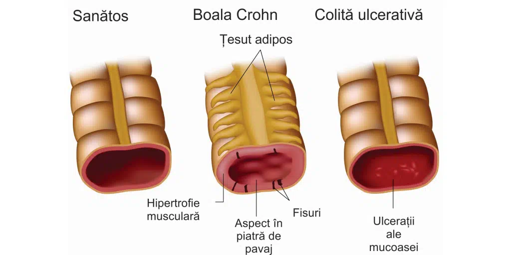 Colita Ulcerativa